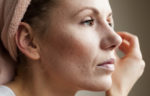 Macro shot of young woman's cheek with acne scarring