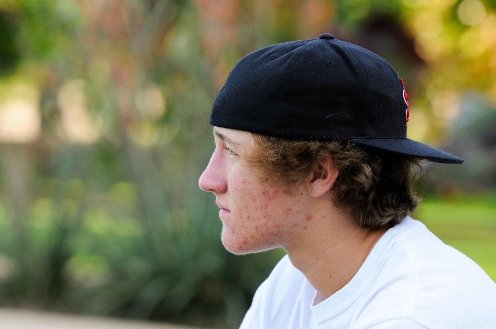 Sad teen boy outdoors with acne looking away from camera with black backwards hat.and white shirt.