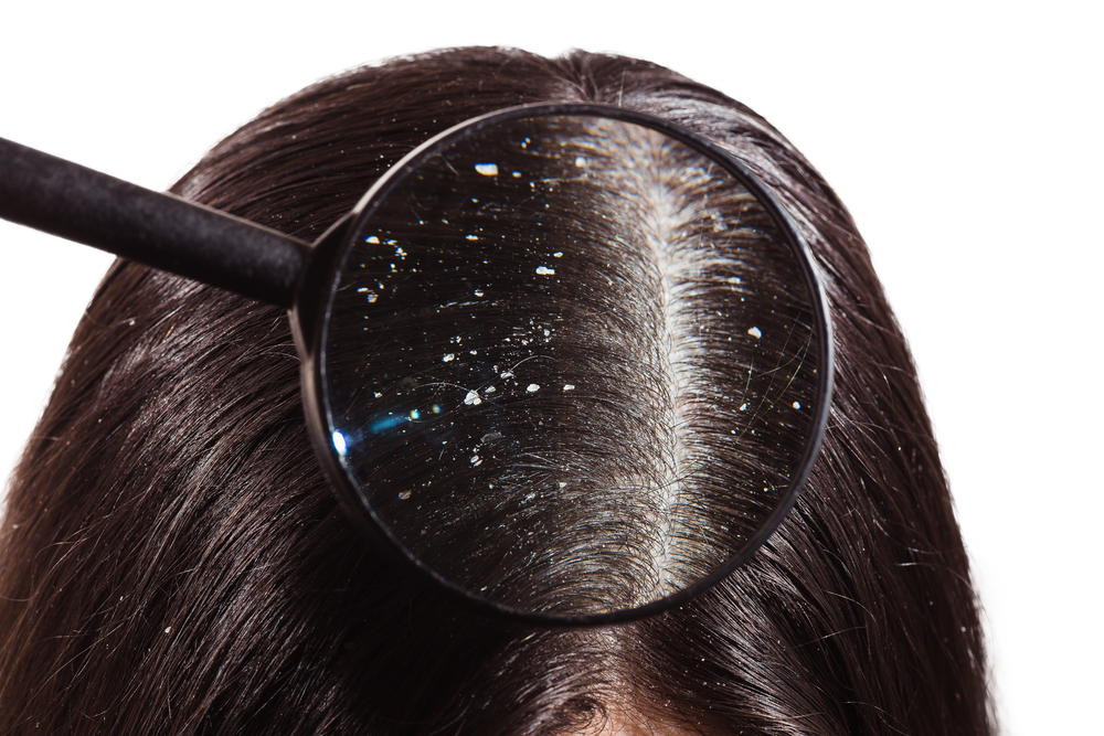 a look through a magnifying glass at the dandruff on dark hair.