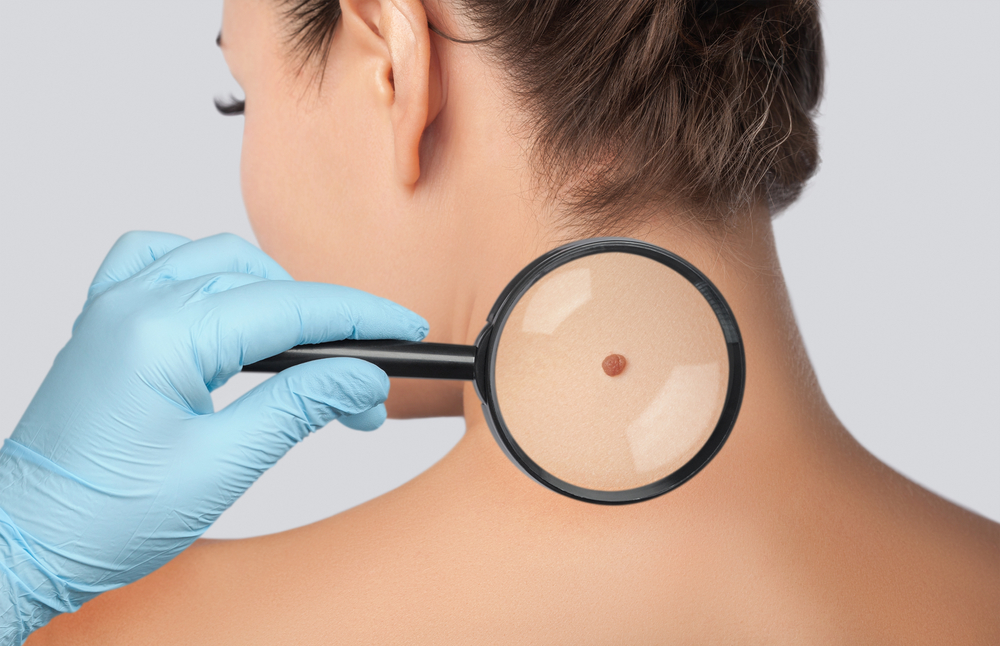 doctor examines a large mole on the shoulder with a magnifying glass.