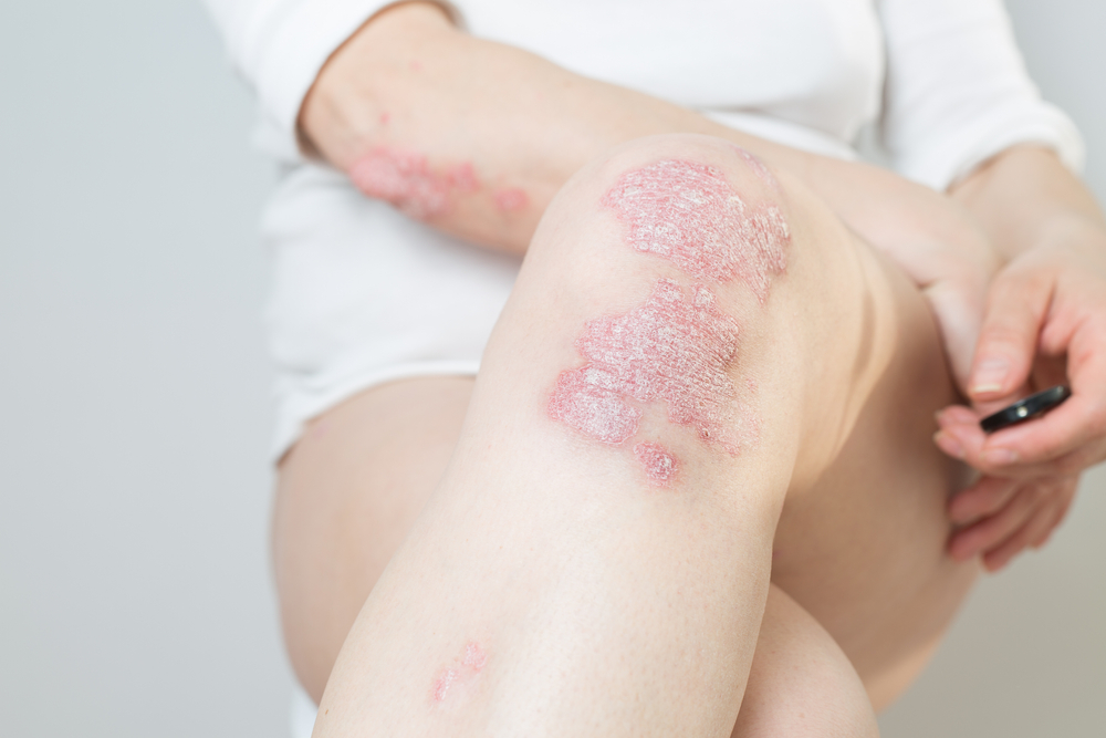 Acute psoriasis on the knees, body, elbows of woman.