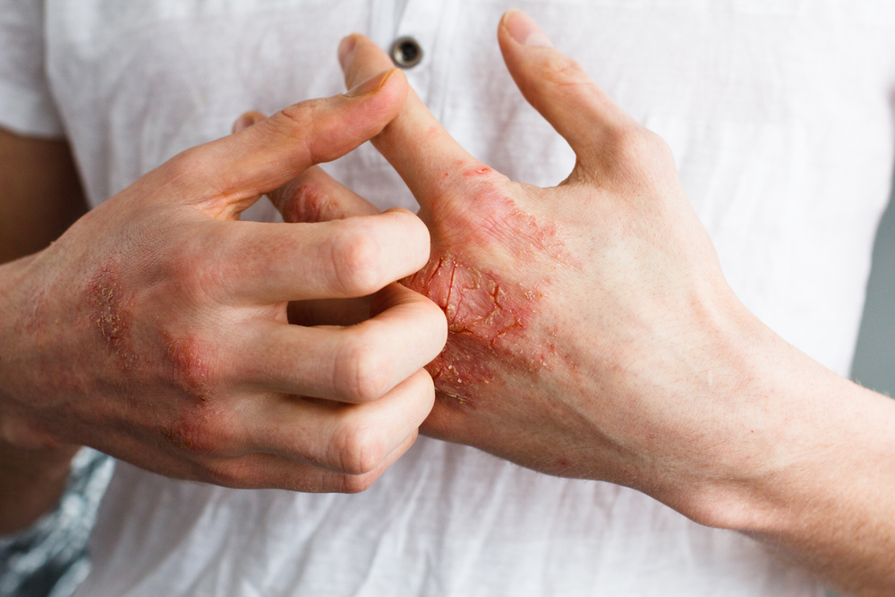 man itching his hand due to adult eczema