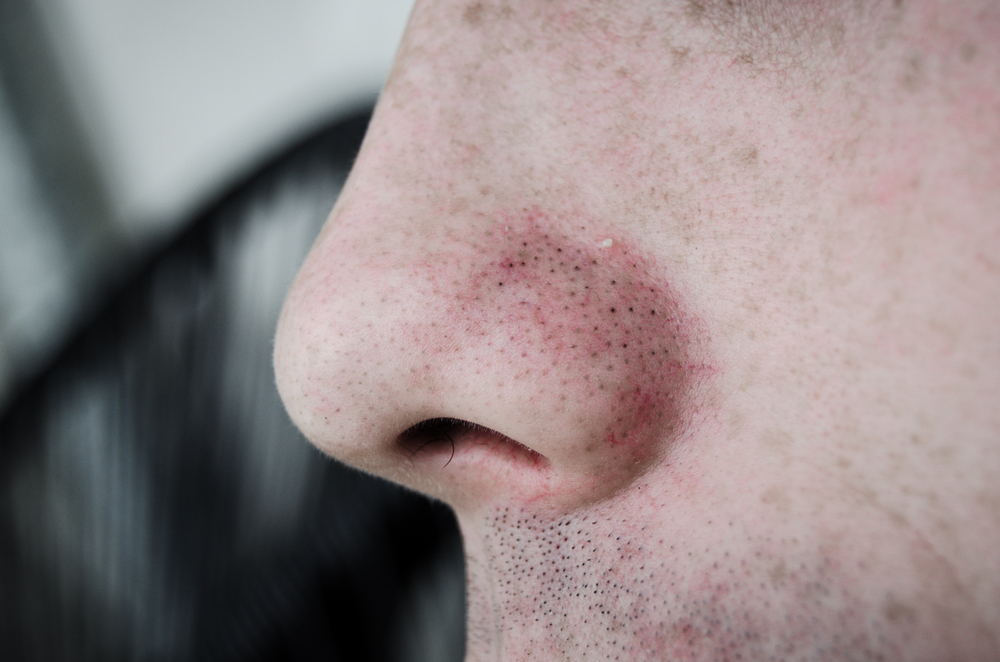 A Nose Full Of Acne And Blackheads