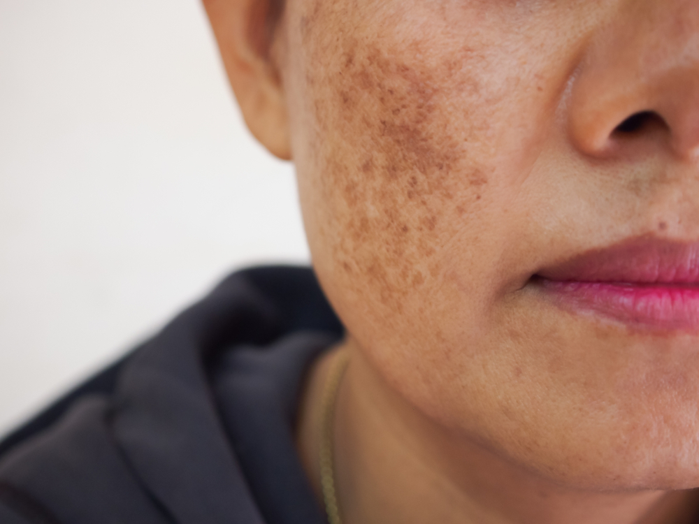 close up of woman's face with melasma.