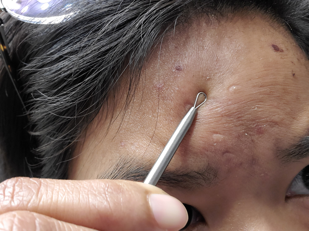 woman using at-home pore extraction tool.