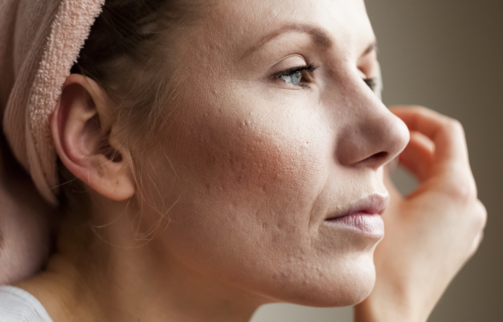 woman with adult acne.