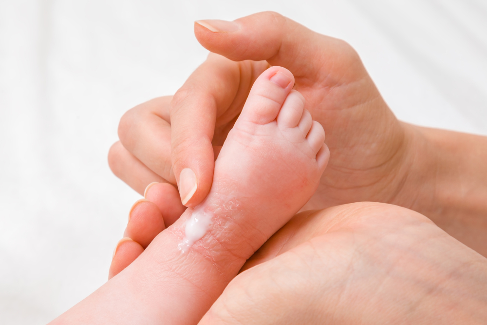 mother applying ointment to baby foot.