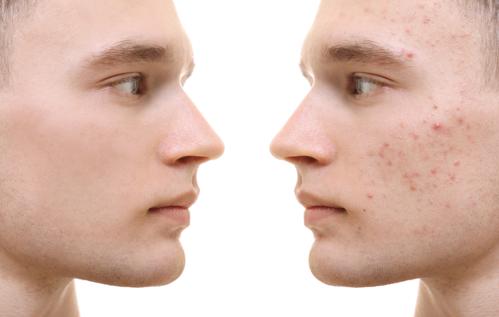 Young man before and after acne treatment.