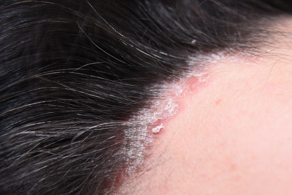 close up of scalp psoriasis.