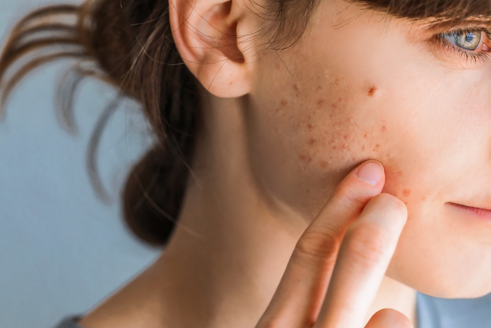 woman looking at her acne.