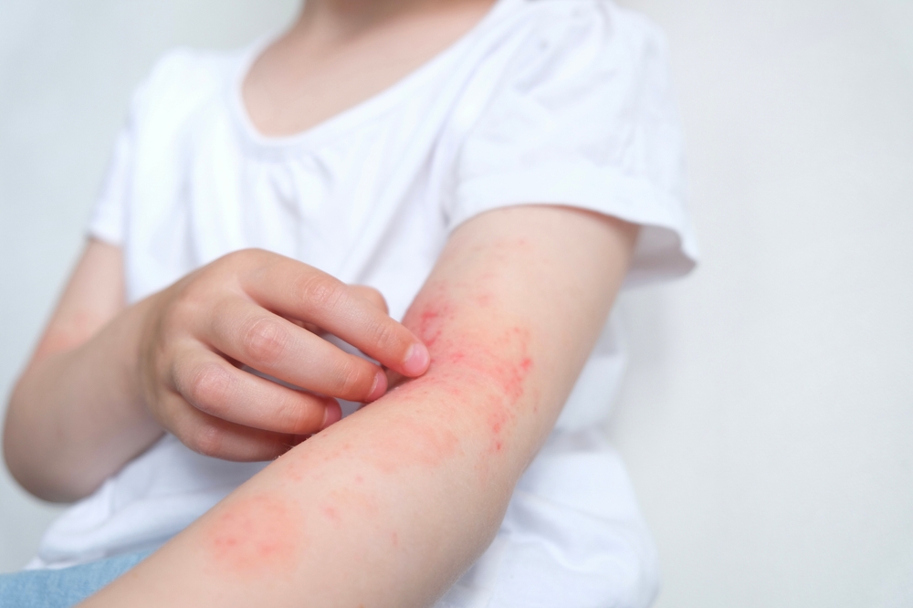 a child with a rash on their arm.