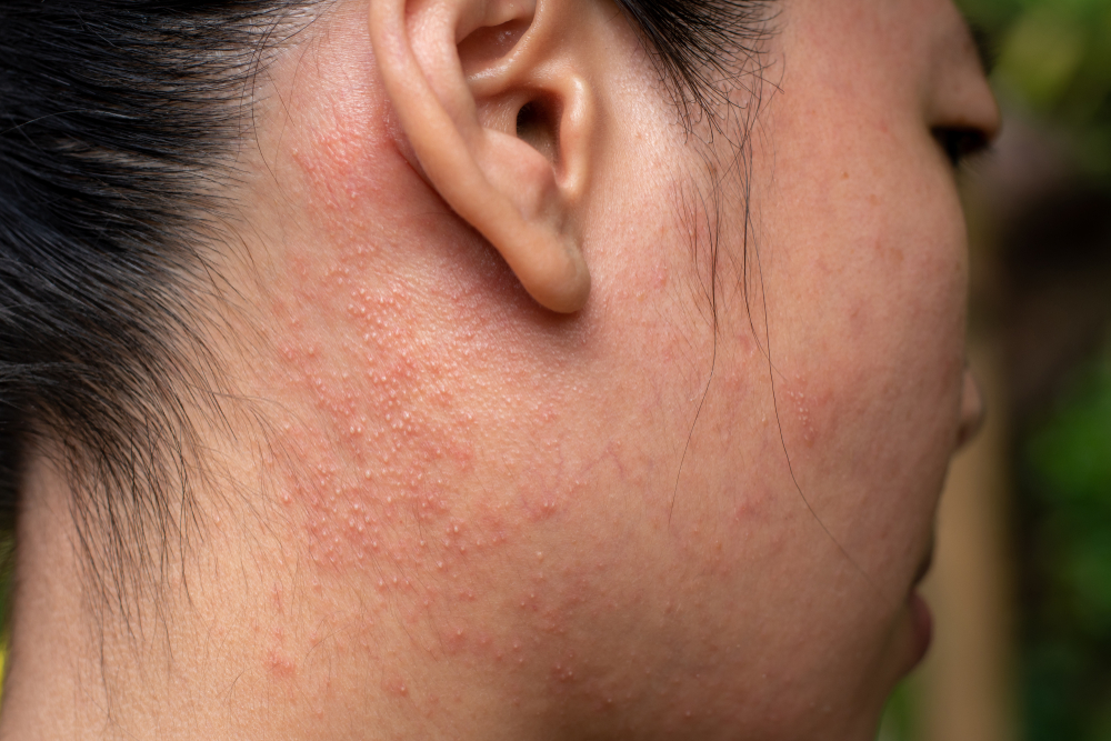 woman with a rash on her face.