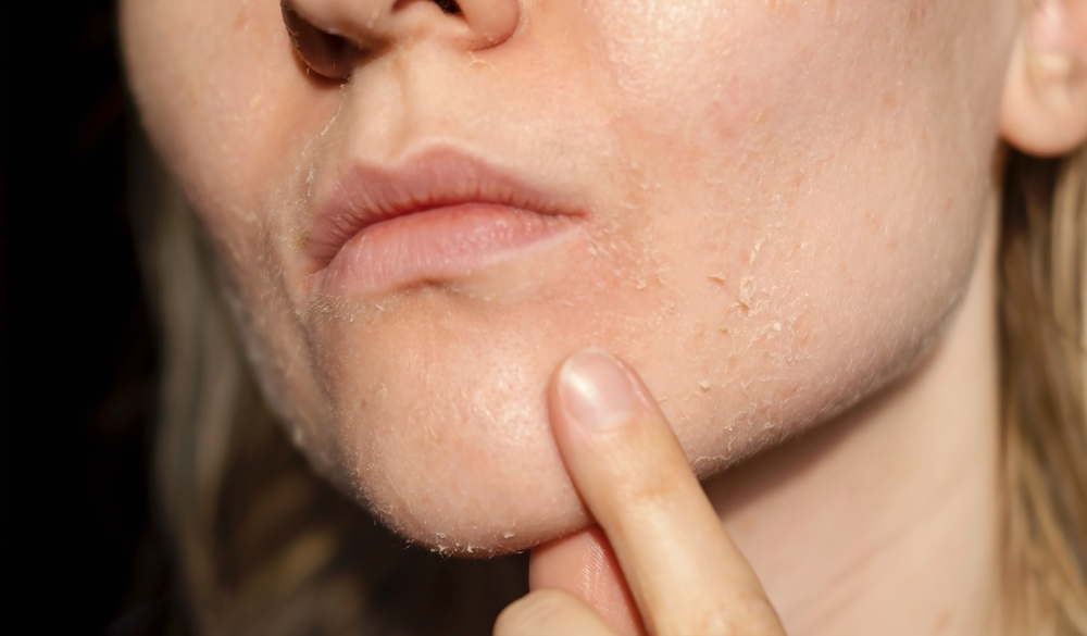 woman with dry skin on her face.