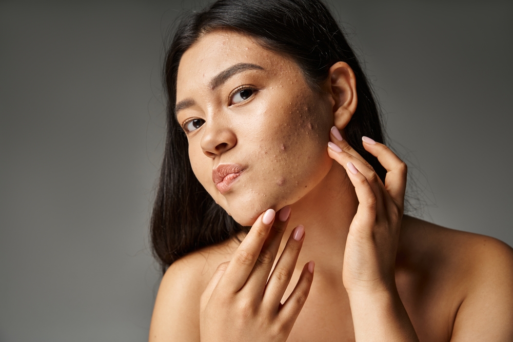 young woman with acne.