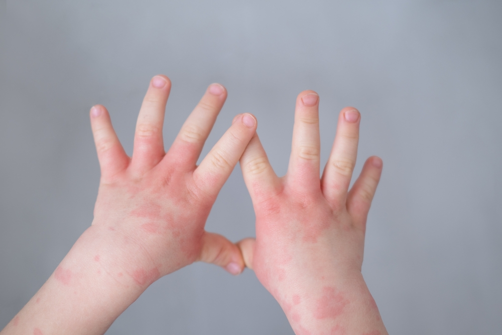 child with eczema on their hands.