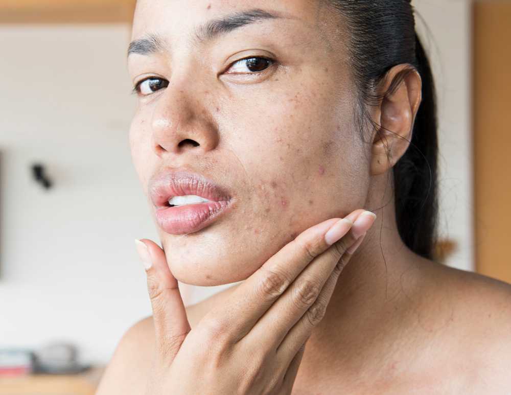 woman with acne.