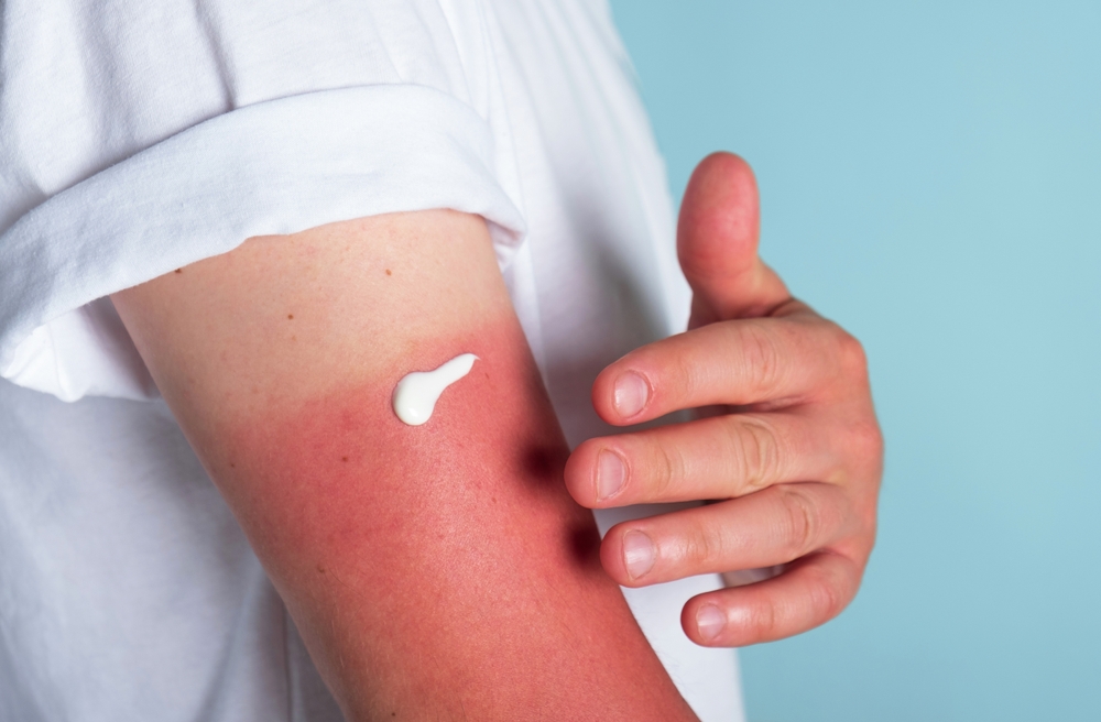 Man applying cream on sunburn.
